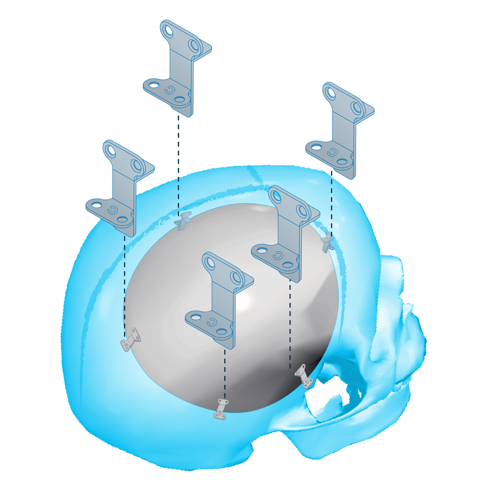 RIALTO Cranial Plate & Screw System