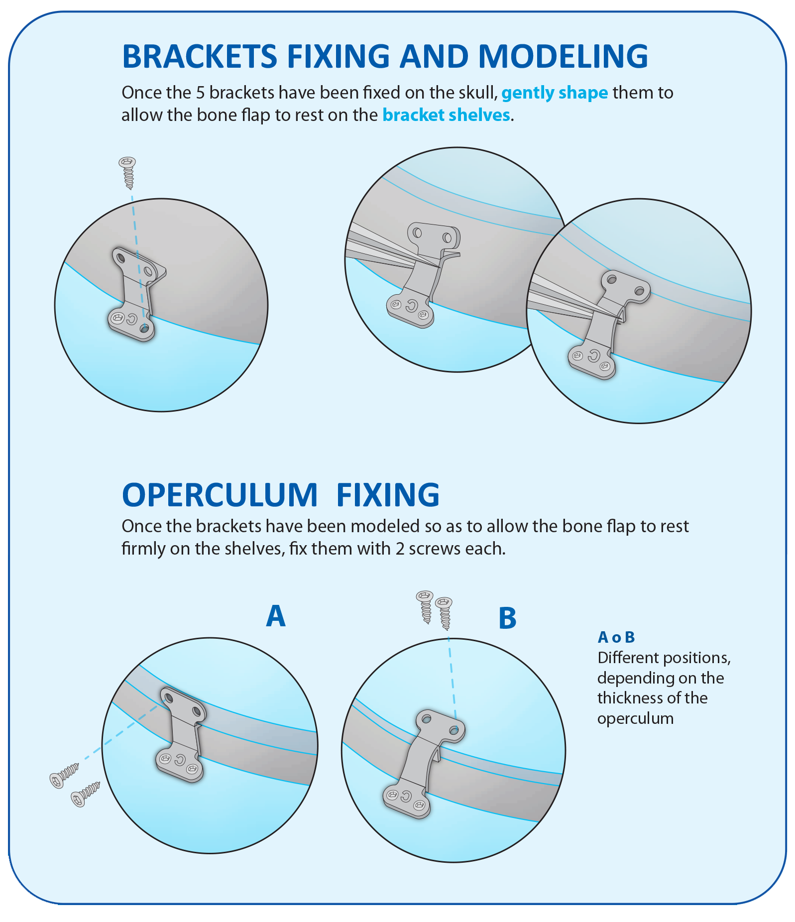 RIALTO bracket fixing and modeling illustrations